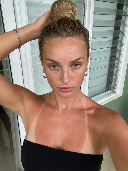 Summer Balcony Selfie Causes a Fire: Clear Sunburn on the Skin